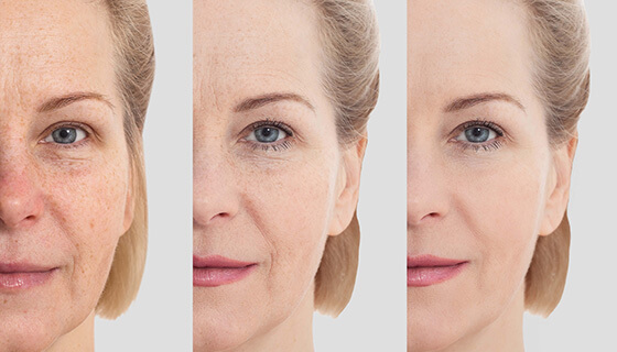 Effect of facial rejuvenation procedures on aging skin, highlighting the science of anti-aging.